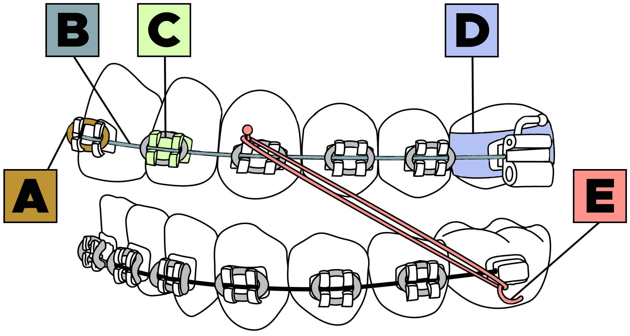 Diagram of the parts used in orthodontic braces