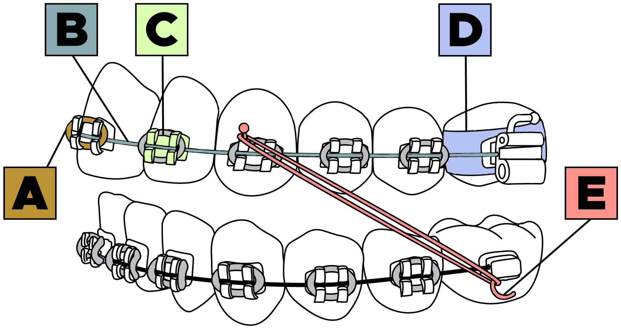 Diagram of the parts used in orthodontic braces