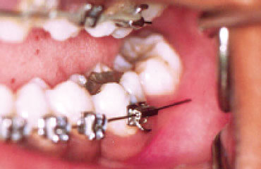 Memory Wire Braces  Pacific Dental Care