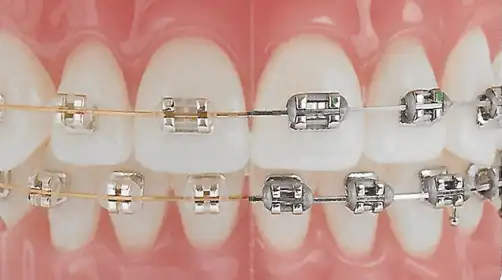 Types of Braces, Metal, Ceramic & Gold Braces